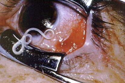 Worms in one's eyes